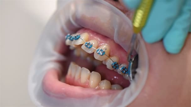 Le dentiste examine les dents avec les orthèses. Extrême gros plan
 - Séquence, vidéo