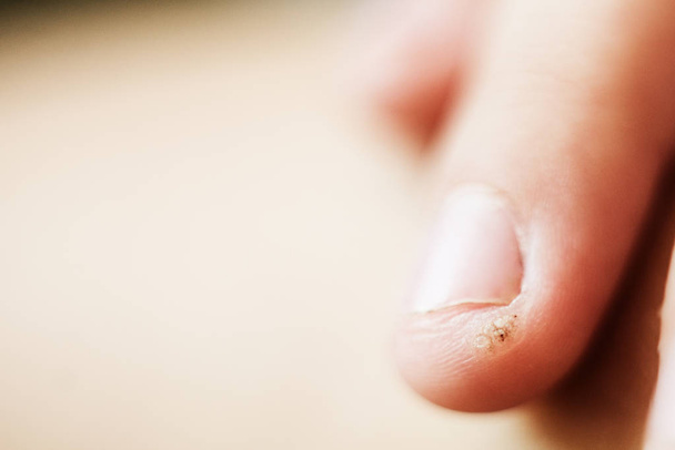 wart, papilloma on a childs finger. Macro shot, selective focus, close-up, space for text. Dermatological problems with the skin - Photo, Image