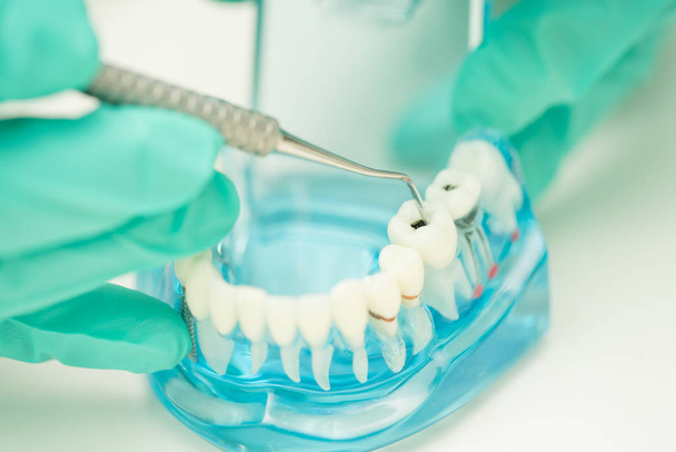 Close-up tandarts hand gebruik tandheelkundige gereedschap reiniging cariës - Foto, afbeelding