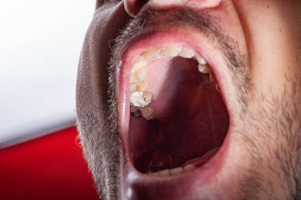 bir diş çürüme hastanın geçici doldurma - Fotoğraf, Görsel