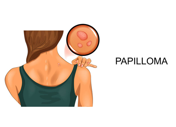 papiloma humano nas costas femininas
 - Vetor, Imagem