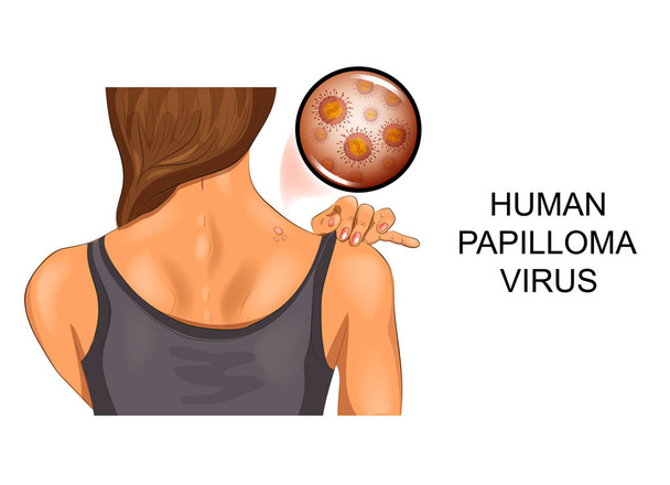 lidská papilomu na ženské zadní - Vektor, obrázek