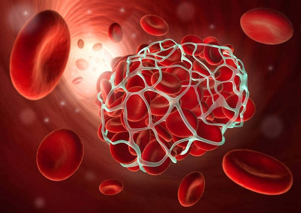 Medizinische Illustration eines Blutgerinnsels oder Thrombus - Gerinnung - 3D Illustration - Foto, Bild