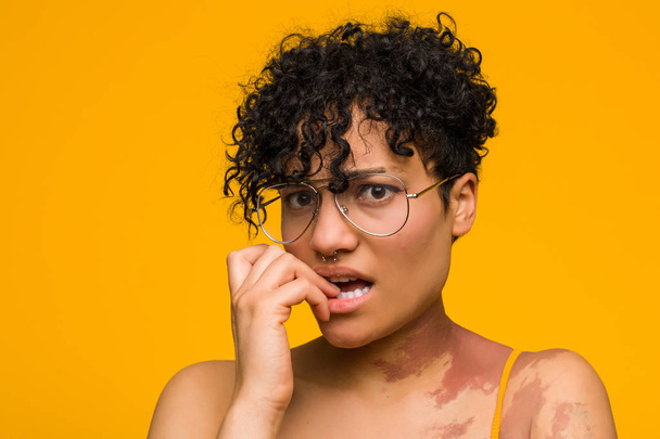 皮膚の出生マークを持つ若いアフリカ系アメリカ人女性が爪を噛み、神経質で非常に心配している. - 写真・画像