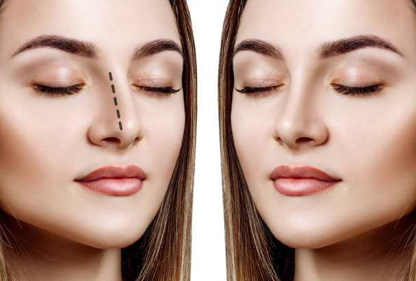 Жіночий ніс до і після косметичної хірургії
. - Фото, зображення