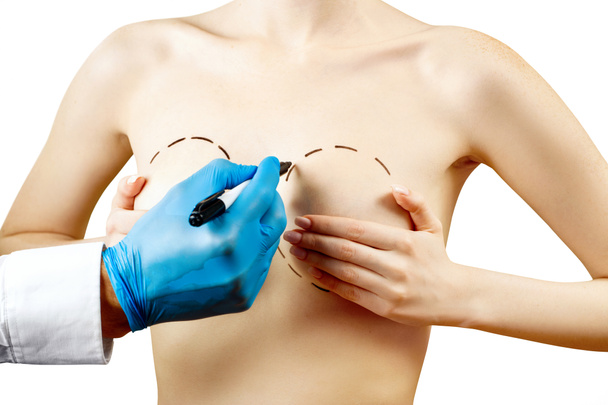 Πλαστική χειρουργική για τη διόρθωση του γυναικείου μαστού. - Φωτογραφία, εικόνα
