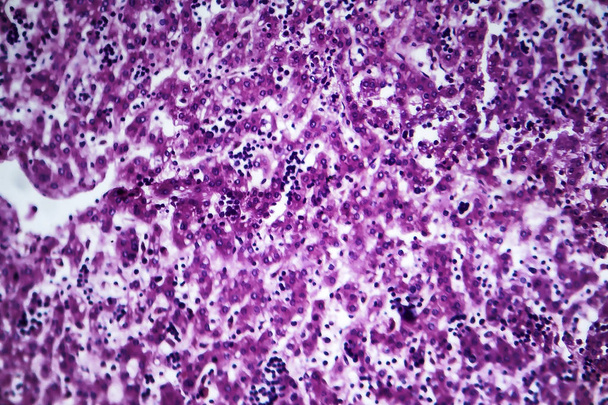 Chronisch aktive Hepatitis, leichte Mikrographie - Foto, Bild