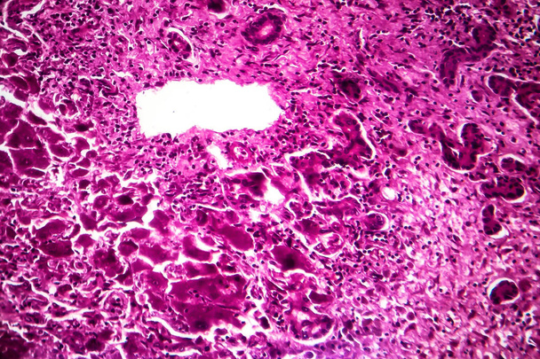 Altakut şiddetli hepatit, hafif mikrograf - Fotoğraf, Görsel