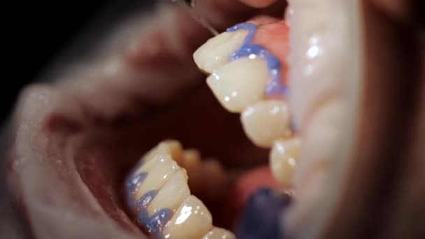 Close-up bleken van de tanden van de vrouw - Video