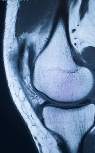 Urazy kolana MRI MCL Tear - Zdjęcie, obraz
