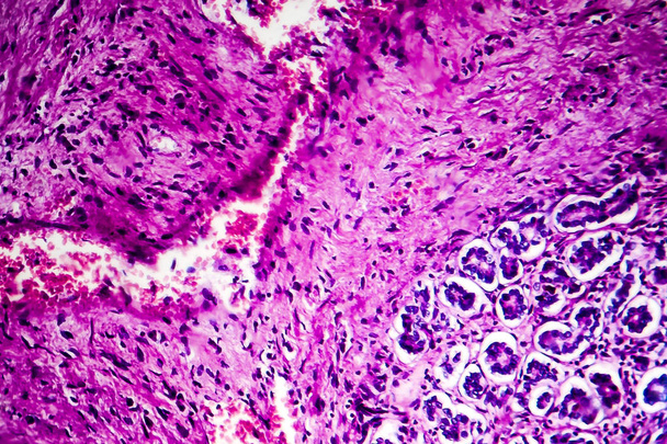 Histopatologie biliární cirhózy - Fotografie, Obrázek