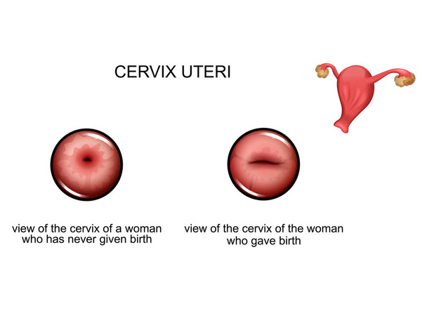 děložního čípku před a po porodu - Vektor, obrázek