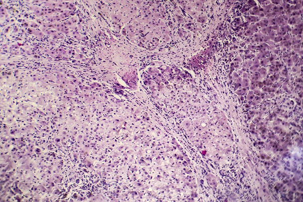 Histopatologie postnekrotické jaterní cirhózy - Fotografie, Obrázek