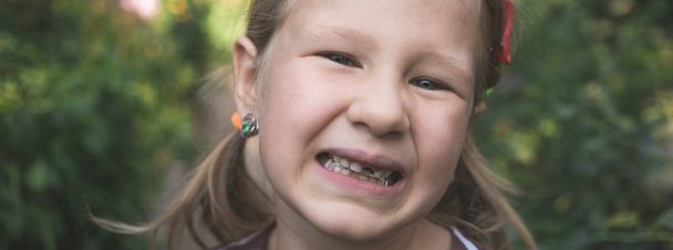 Child with a dental orthodontic device and without one tooth - Foto, Imagen