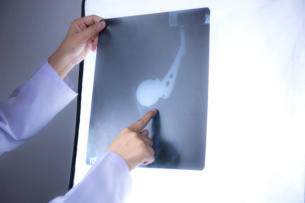 Το χέρι του γιατρού δείχνει το ακτινογραφικό φιλμ του ατόμου που χρησιμοποιεί με συμπτώματα αρθρίτιδας. - Φωτογραφία, εικόνα