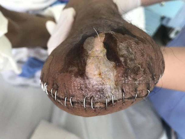 Herida de muñón, esta es una herida de amputación o herida de muñón en la pierna que sutura por grapa.Concepto de atención médica
. - Foto, imagen