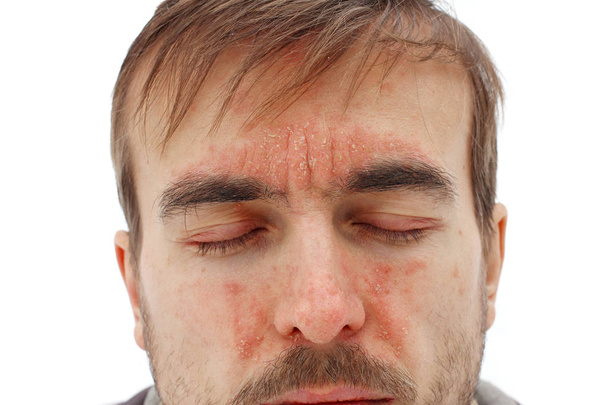 głowa chorego mężczyzny z zamkniętymi oczami z czerwoną reakcją alergiczną na skórze twarzy, zaczerwienieniem i obieraniem łuszczycy na nos, czoło i policzki, sezonowe problemy skórne, białe tło - Zdjęcie, obraz