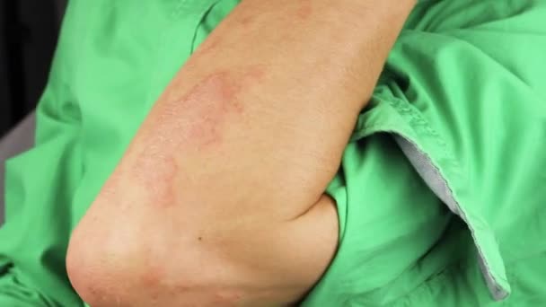 sick man scratches  his hand with red allergic reaction on arm, redness and peeling psoriasis on elbow, seasonal skin problem - Footage, Video