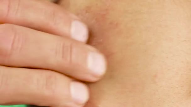 menselijke krassen zijn arm met rode allergische reactie, roodheid en peeling psoriasis op elleboog, seizoensgebonden huidprobleem, close-up macro  - Video
