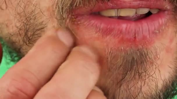 menselijke krassen zijn kin met rode allergische reactie, roodheid en peeling psoriasis op gezicht huid in de buurt van lippen, seizoensgebonden Dermatologie probleem, close-up macro  - Video