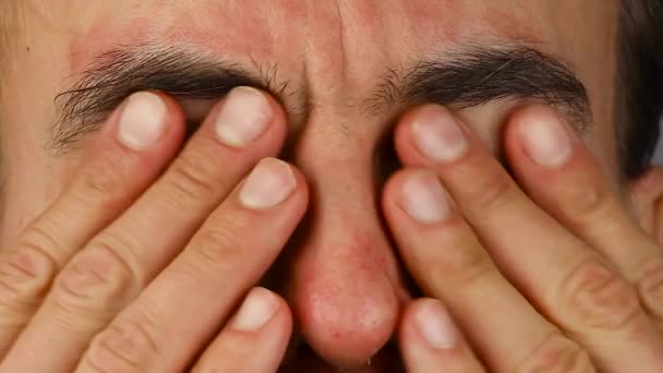 hombre parpadea sus ojos con reacción alérgica roja y arañazos, enrojecimiento y descamación psoriasis en la piel de la cara, problema de dermatología estacional, primer plano
   - Metraje, vídeo