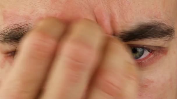 human scratches his forehead and eyes with red allergic reaction, redness and peeling psoriasis on face skin, seasonal dermatology problem, close-up macro  - Materiał filmowy, wideo