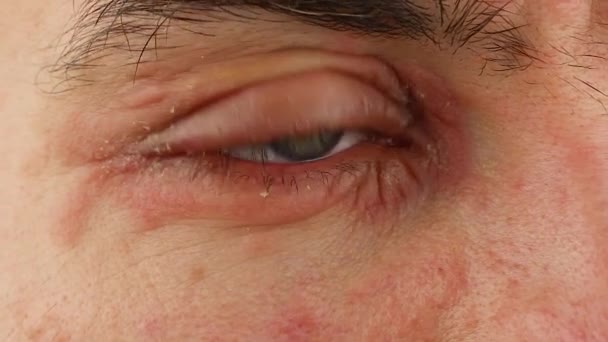 ludzkie rysy jego prawe oko z zapaleniem i czerwona reakcja alergiczna, zaczerwienienie i peeling łuszczycy na skórze twarzy, sezonowe problem dermatologii, makro zbliżenie  - Materiał filmowy, wideo