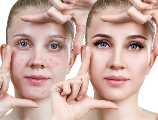Young woman before and after skin treatment and makeup. - Photo, Image