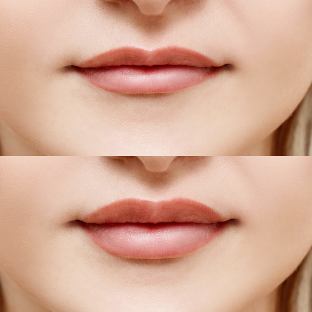 Usta kobiety przed i po augmentacji. - Zdjęcie, obraz