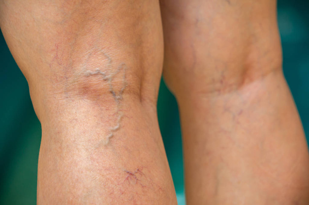 Varicose veins on the back of knees and legs in woman, Blurred blue swimming pool background, Close up and macro shot, Selective focus, Asian Body skin, Healthcare and Beauty concept - Photo, Image