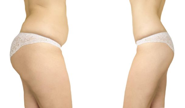жінка надмірна вага целюліту до і після дієти
 - Фото, зображення