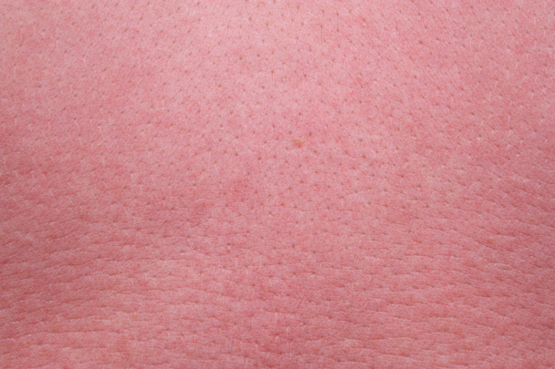 starke Haut mit Sonnenbrand - Foto, Bild