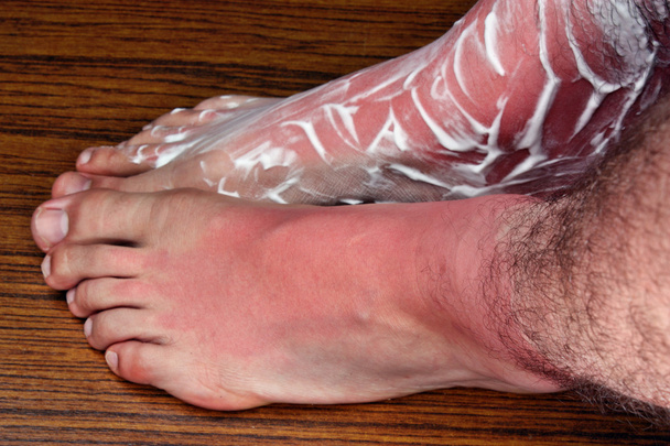 Beine mit Sonnenbrand - Foto, Bild