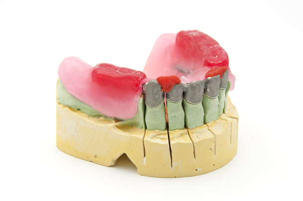 Dental bridge - Photo, Image