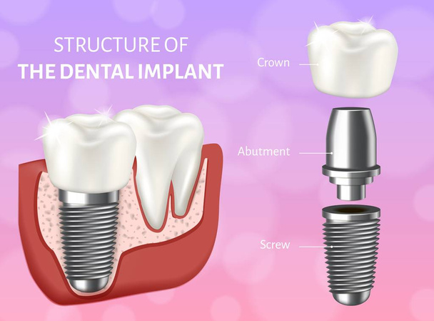 Ilustracja wektorowa przedstawiająca strukturę implantu dentystycznego. Koncepcja projektu procesu implantologicznego. - Wektor, obraz