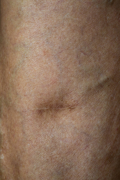 Litteken van werken op spataderen op een been in senior vrouwen, close-up & macro shot, selectieve focus, lichaamshuid deel, gezondheidszorg concept - Foto, afbeelding