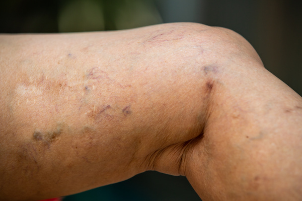 Varicose veins on a leg in Senior women, Close up & Macro shot, Selective focus, Asian body skin part, Healthcare concept - Photo, Image
