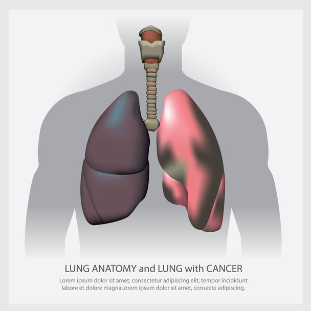 Illustration détaillée et vectorielle du cancer du poumon - Vecteur, image