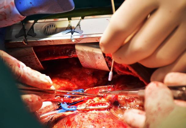 A doctor is connecting graft vessel with coronary artery in off pump coronary artery bypass surgery (OPCAB) with stabilization tool for stable narrow area. - Photo, Image