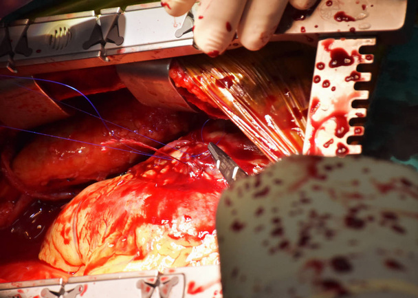 Un medico sta collegando l'innesto del vaso all'arteria coronaria nell'intervento di bypass coronarico mentre il sangue sanguina
. - Foto, immagini