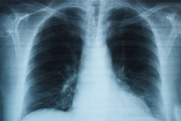 X-ray kép az emberi mellkas. Tüdő-egészségügyi problémák. - Fotó, kép