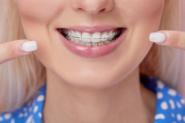 Красивий макрознімок білих зубів з брекетами. Фото догляду за зубами. Красива жінка посміхається з еротичними аксесуарами. Лікування ортодонтії. Крупним планом здоровий жіночий рот
 - Фото, зображення