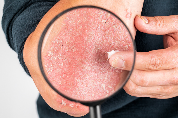 stosowanie zmiękczającego środka na suchą łuszczącą się skórę, jak w leczeniu  - Zdjęcie, obraz