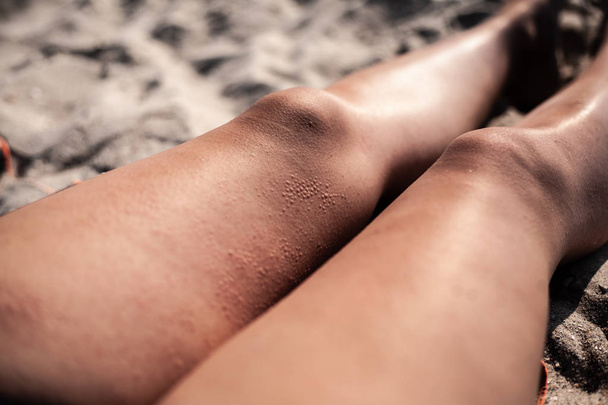 Buborékfólias a bőrön. A lábát a napsütéses időjárás, hólyagok a csípő. - Fotó, kép