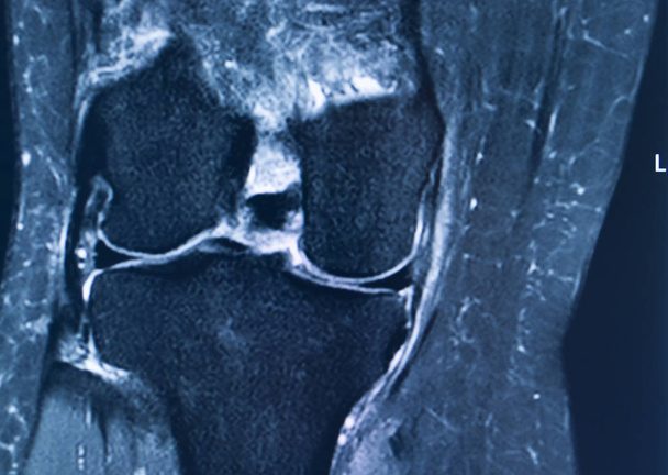 Knie letsel MRI mcl scheur - Foto, afbeelding