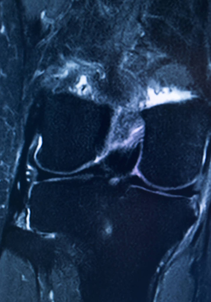 Knee injury mri mcl tear - Photo, Image