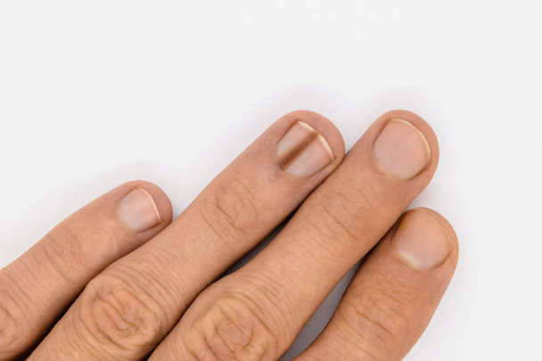 Uña de dedo con melanoniquia
 - Foto, imagen