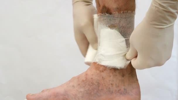 人間の皮膚病人は、おそらく彼の足の静脈瘤に起因する、傷跡、潰瘍および年齢の斑点の周りに包帯で洗い引く. - 映像、動画