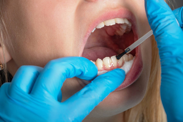 Odontología. La paciente es una adolescente con la boca abierta. El médico unta los dientes con esmalte protector, primer plano, vista frontal
. - Foto, imagen