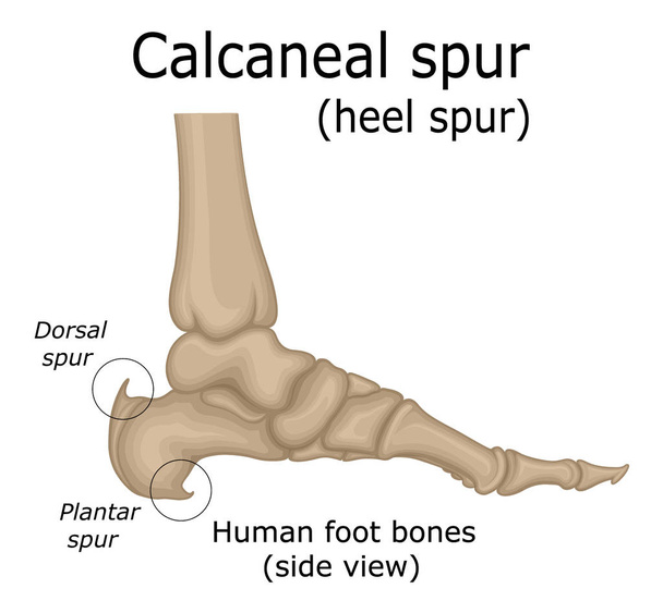 Illustrazione dello sperone del tallone, che è un deposito di calcio che favorisce la comparsa di una sporgenza ossea sul tallone
 - Vettoriali, immagini